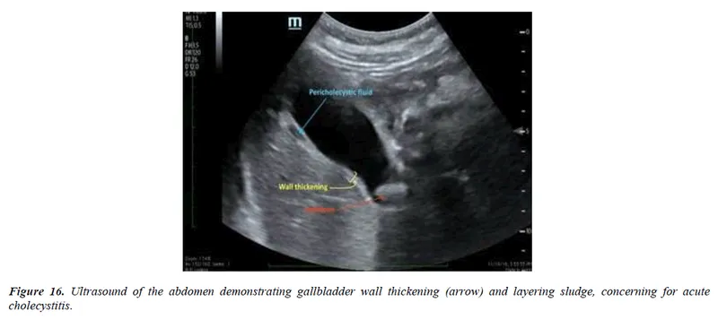 Ultrasound of acute cholecystitis