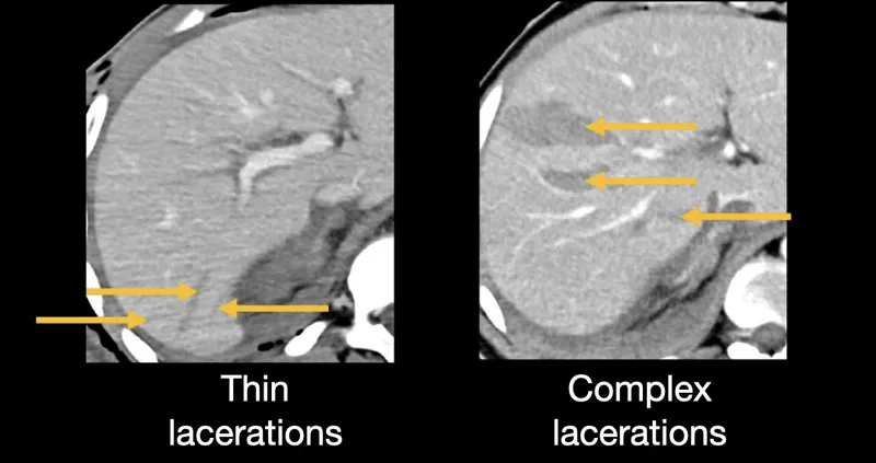 CT showing thin vs complex liver lacerations