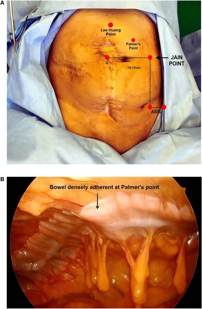 Bowel Adhesion at Palmer's Point