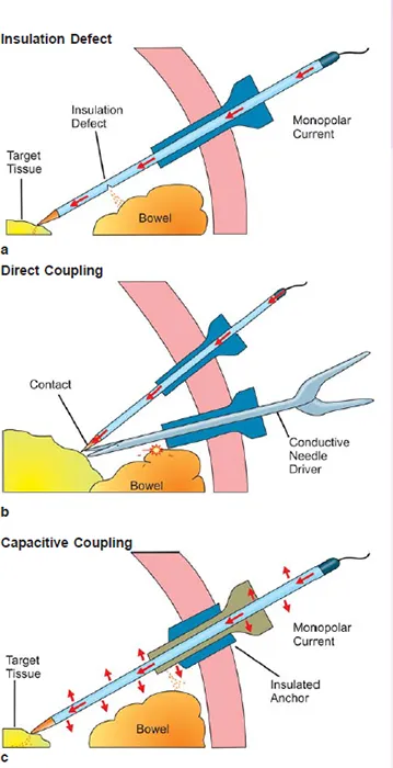 Electrosurgical burns: insulation defect, direct, capacitive