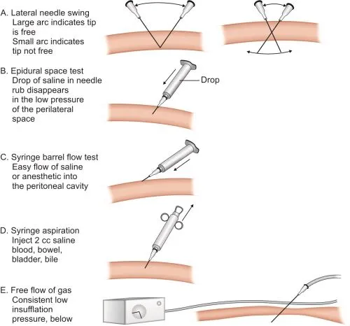 Veress needle confirmation tests