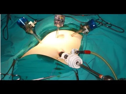 Laparoscopic Appendectomy Port Placement