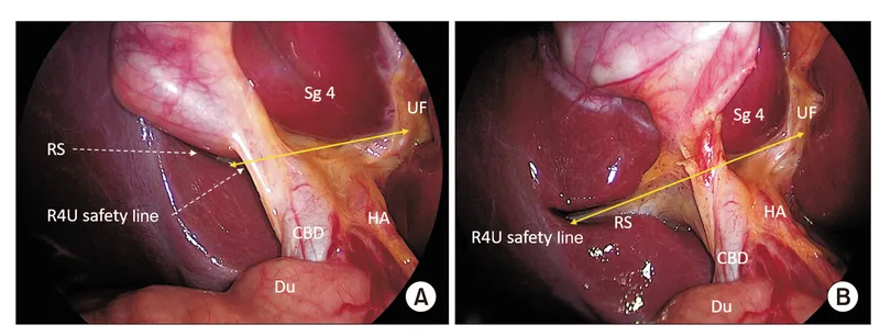 Calot's triangle anatomy for laparoscopic cholecystectomy