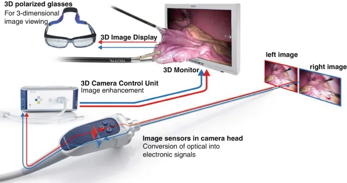 3D Laparoscopic Vision System Diagram