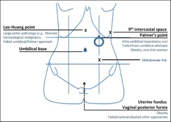 Laparoscopic entry points and considerations