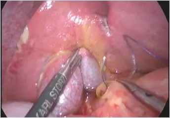 Laparoscopic Graham patch repair