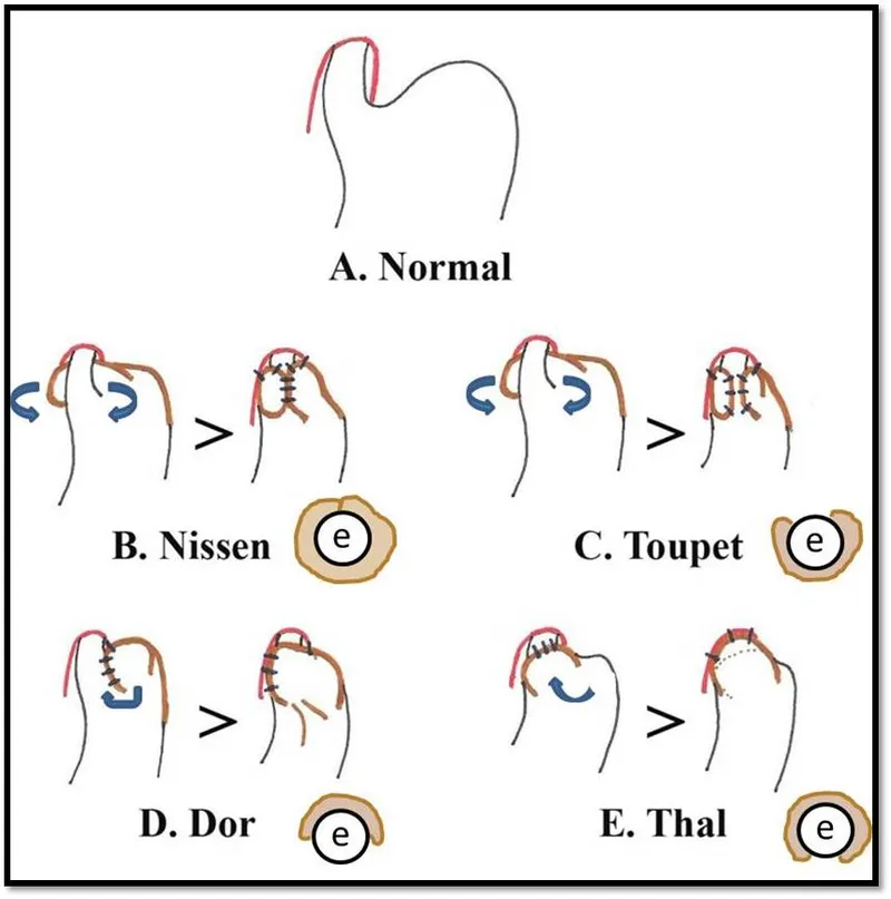 Fundoplication techniques