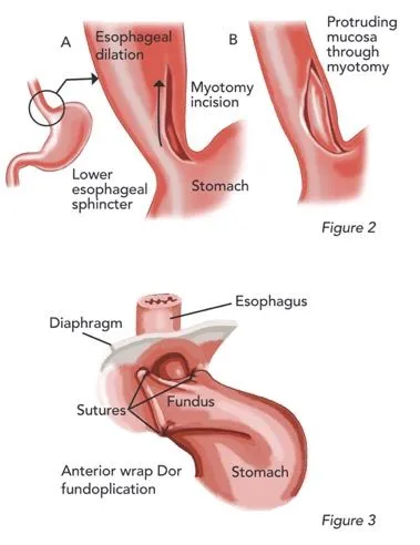 Heller Myotomy and Dor Fundoplication Diagram