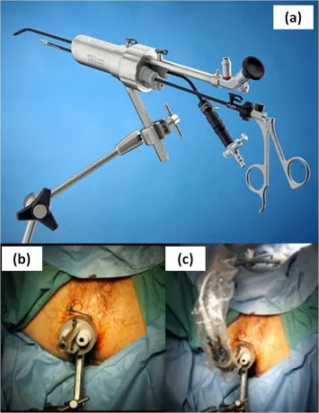 NOTES surgical tools and procedure