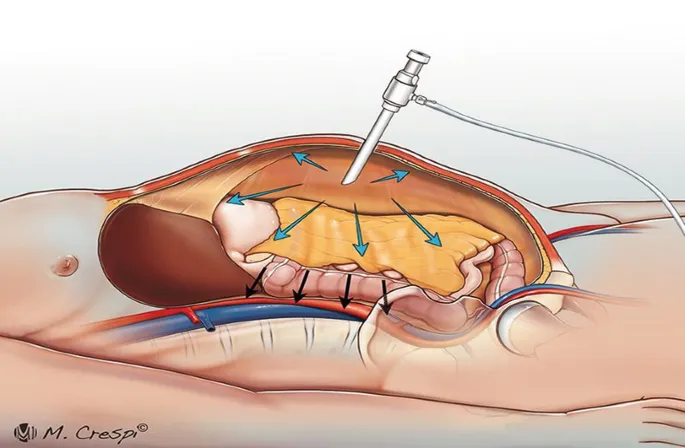 Pneumoperitoneum effects on abdominal organs