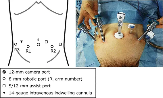 Robotic radical prostatectomy port placement
