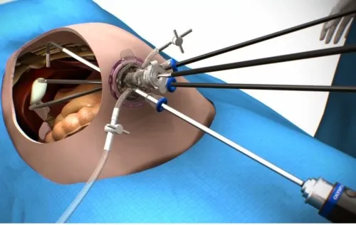 Single Incision Laparoscopic Surgery port and instruments