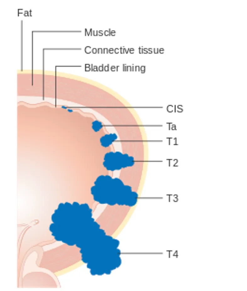Bladder Cancer T Staging Diagram