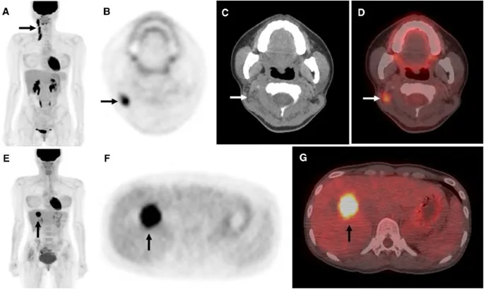 PET-CT showing cancer recurrence
