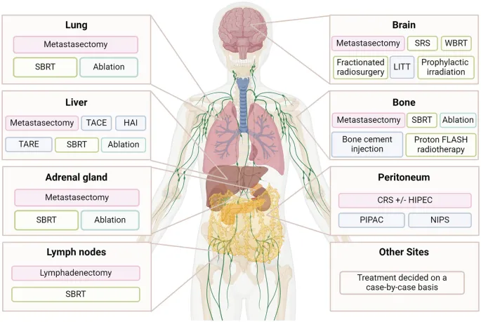 Metastasectomy and other treatments by site