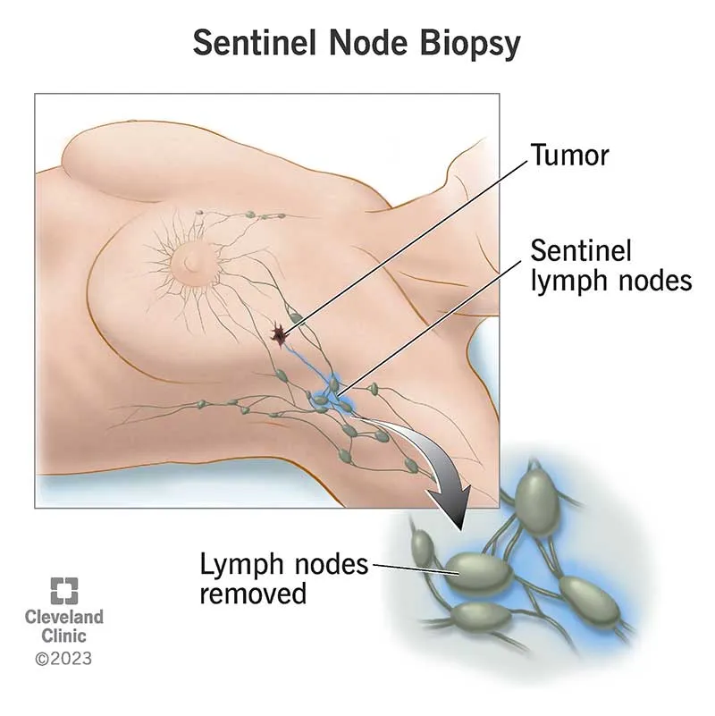 Sentinel Lymph Node Biopsy Diagram