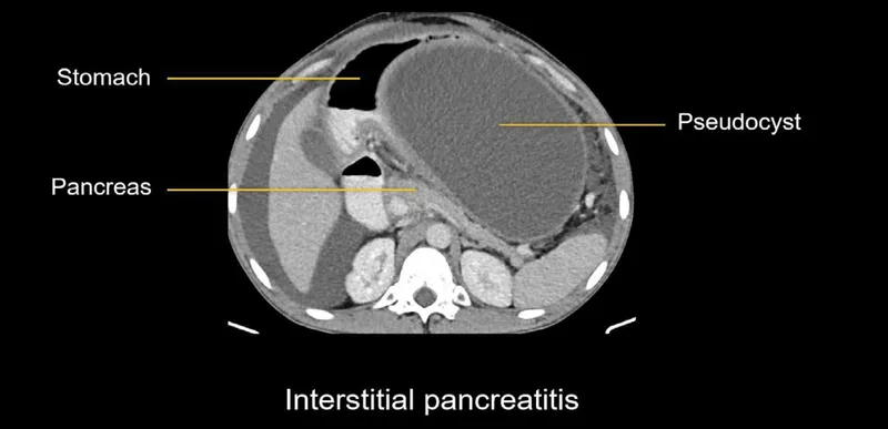 CT scan of pancreatic pseudocyst