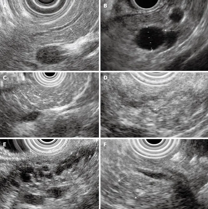 EUS features of chronic pancreatitis
