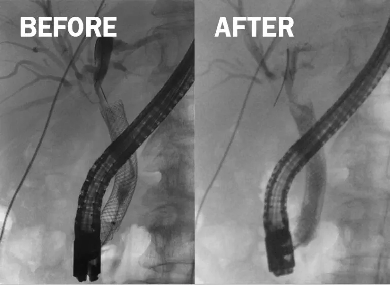 ERCP of biliary stricture post pancreatic surgery