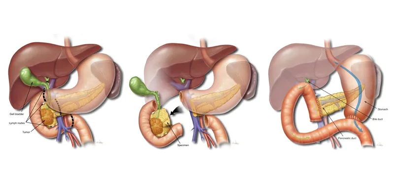 Whipple procedure: resection and reconstruction