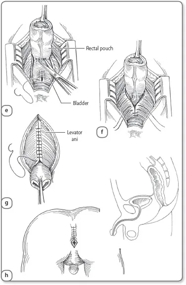 PSARP surgical steps
