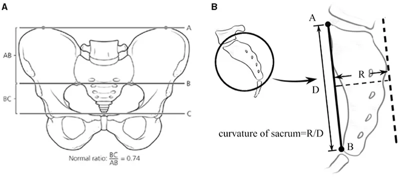 Sacral Ratio and Curvature Measurement for ARM Prognosis
