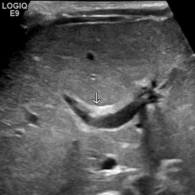 Ultrasound: Triangular cord sign in biliary atresia