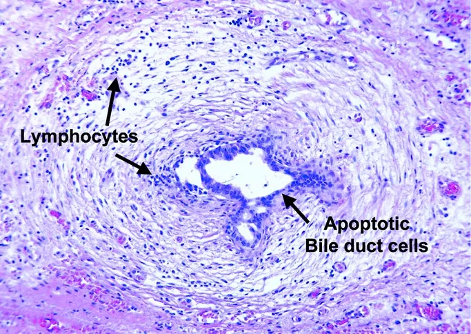 Histology of biliary atresia showing lymphocytes