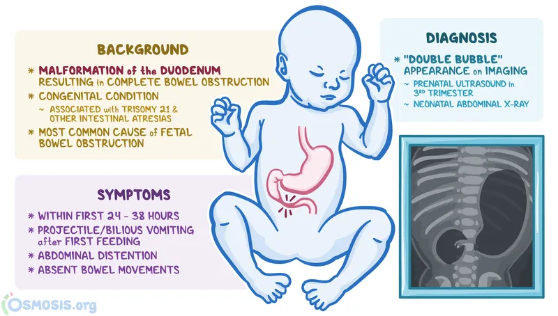 Duodenal Atresia: Background, Symptoms, Diagnosis
