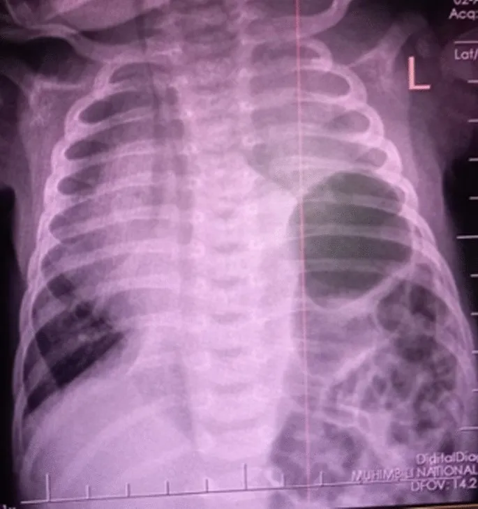 Neonatal CDH Chest X-ray: Bowel in chest, mediastinal shift