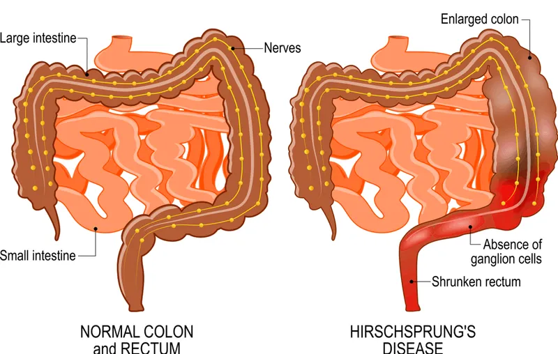 Hirschsprung's Disease vs Normal Colon