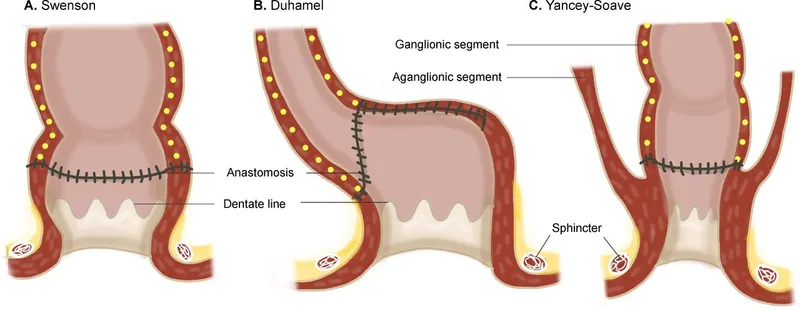 Surgical procedures for Hirschsprung's disease