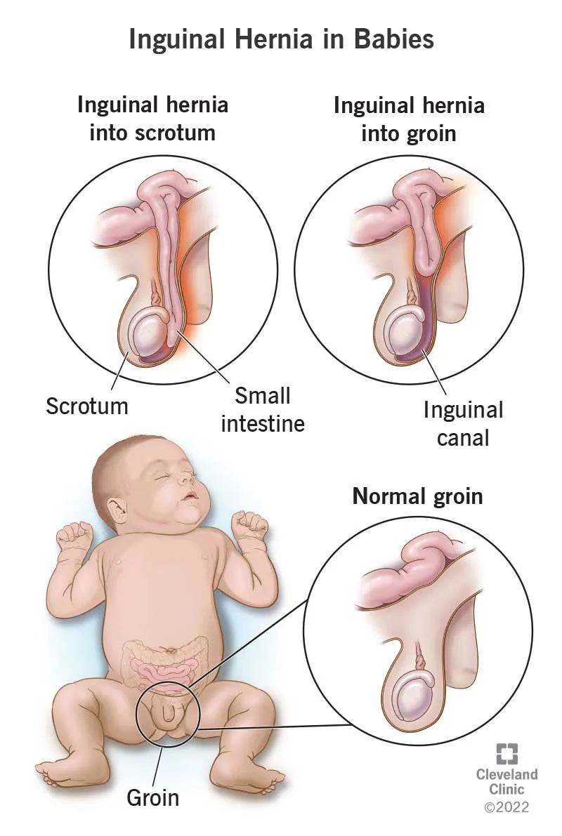 Inguinal Hernia in Babies