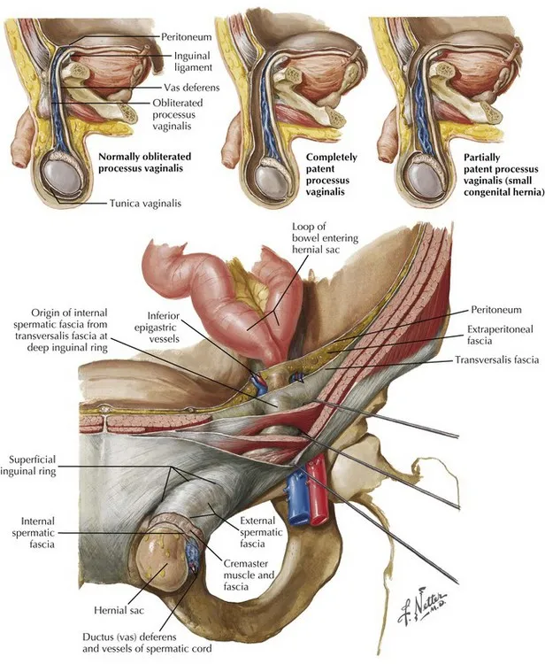 Pediatric Inguinal Hernia Anatomy & Processus Vaginalis