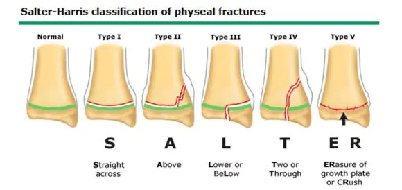 Salter-Harris fracture classification