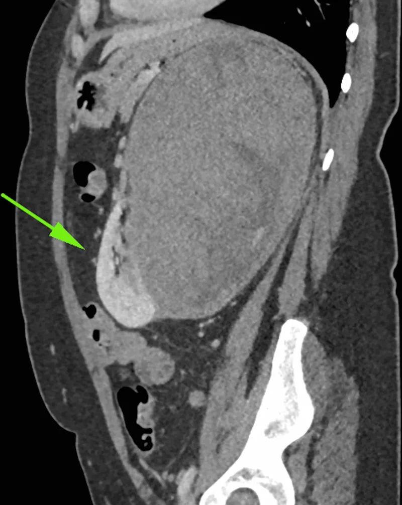 Sagittal CT showing large Wilms tumor