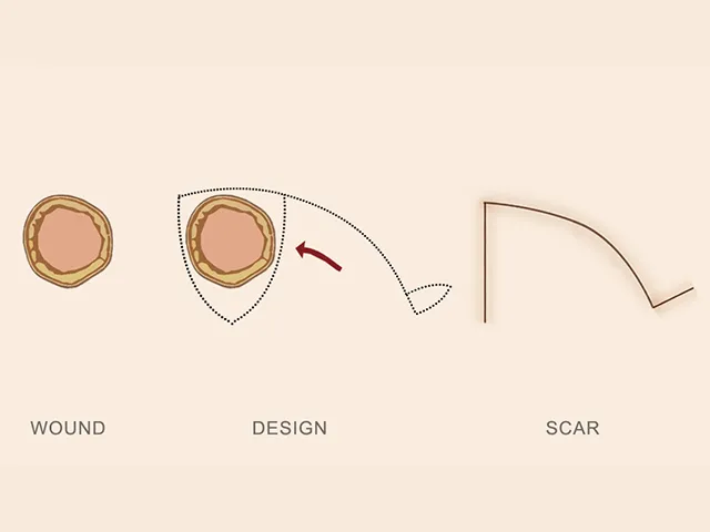 Rotation flap design and resulting scar