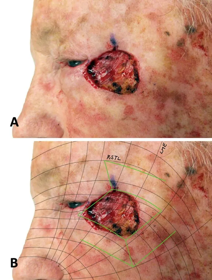 Local flap design showing RSTL alignment