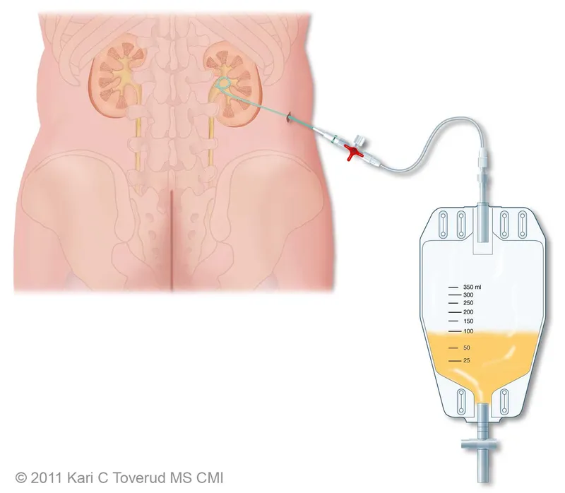 Percutaneous nephrostomy drain and collection bag