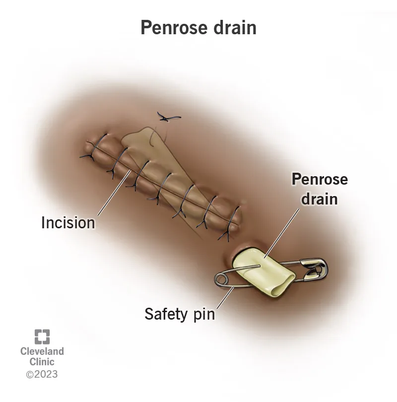 Penrose drain placement with safety pin