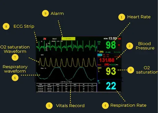PACU Monitor Displaying Vital Signs and EKG Rhythm
