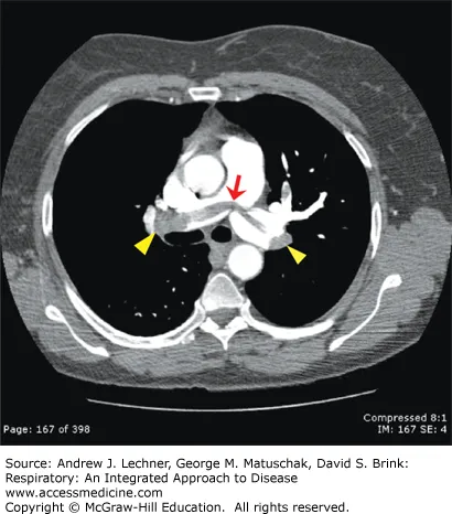 CT angiogram showing saddle pulmonary embolism