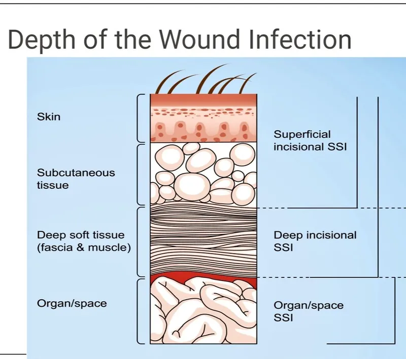 Surgical site infection (SSI) depth by tissue layer