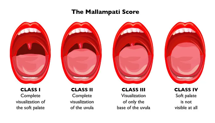Mallampati Classification Diagram (Classes I-IV)