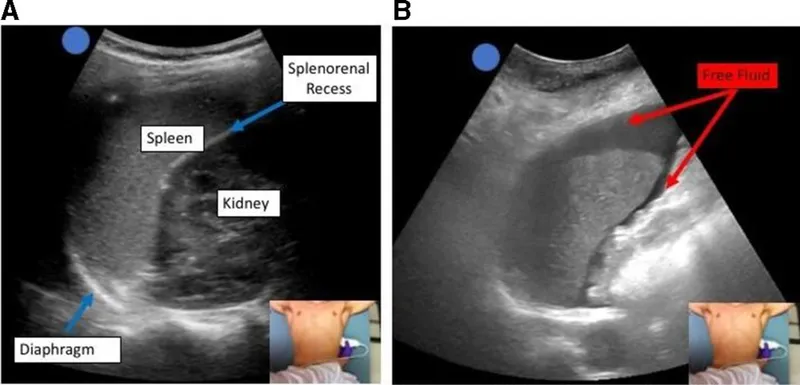 FAST exam: Splenorenal recess with and without free fluid