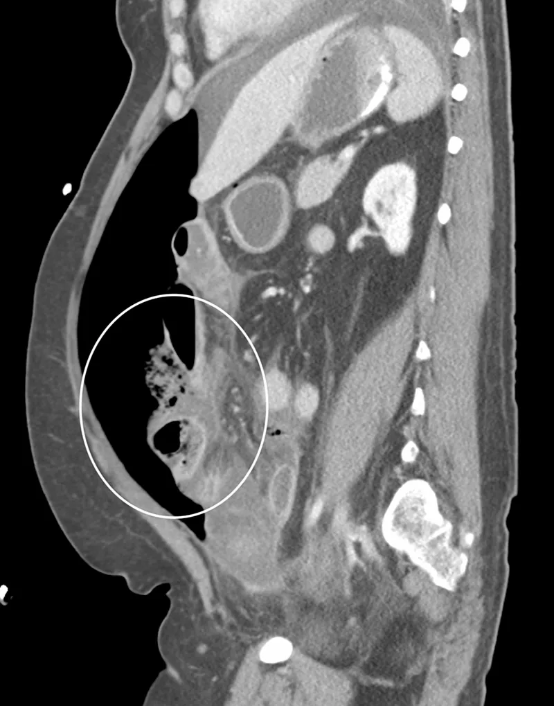 CT scan showing intra-abdominal abscess