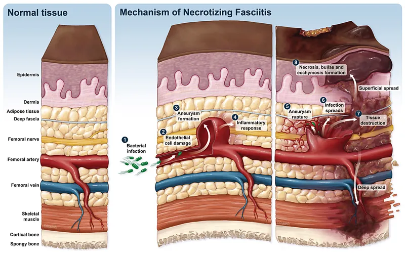 Microscopic view of necrotizing fasciitis