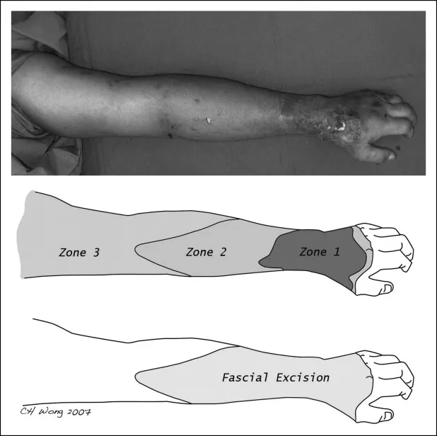 Necrotizing fasciitis zones and surgical approach