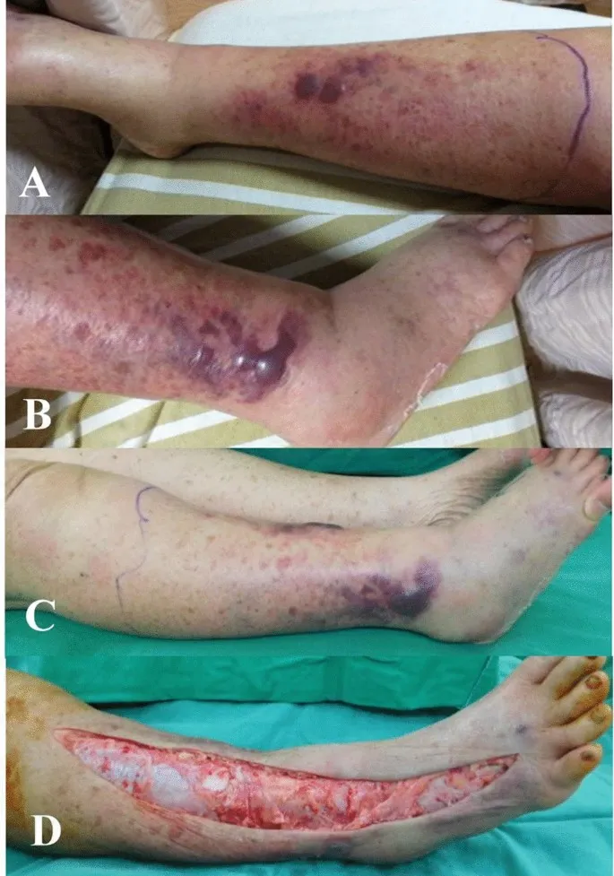 Necrotizing Fasciitis Progression & Debridement