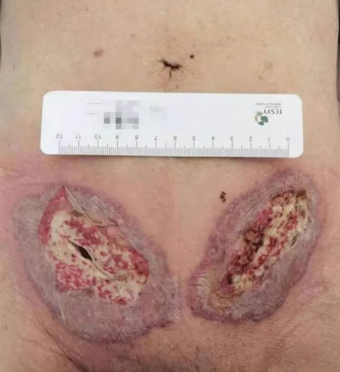 Surgical Site Infection with Wound Dehiscence